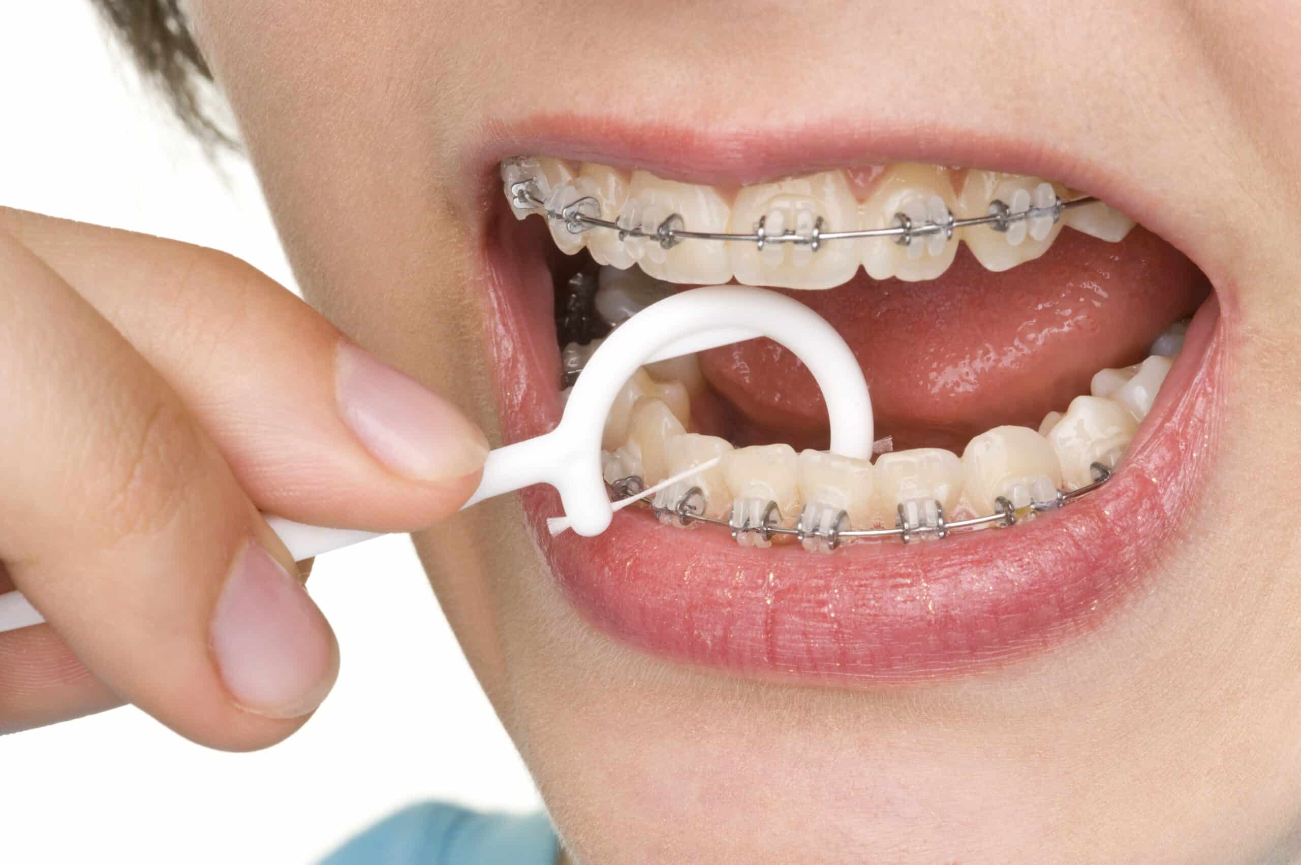 Featured image for “Teeth Cleaning in Mt. Vernon, OH: Why It’s Essential for Your Oral Health”