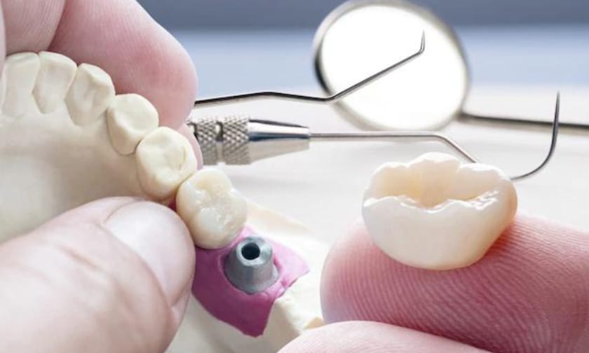 Dental Crown Danville