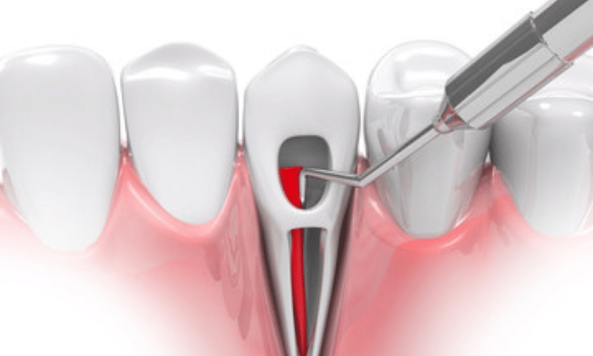 Root Canal Therapy