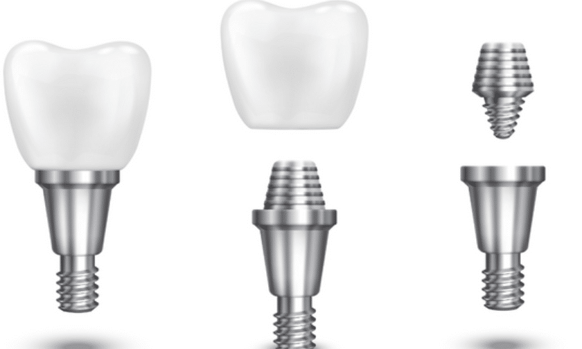 Implant Dentist Danville