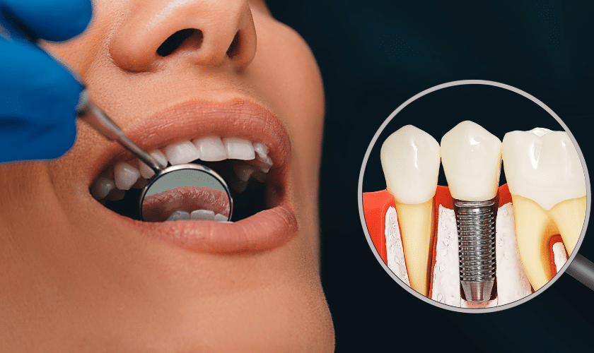 Dental implants-Danville Family Dental