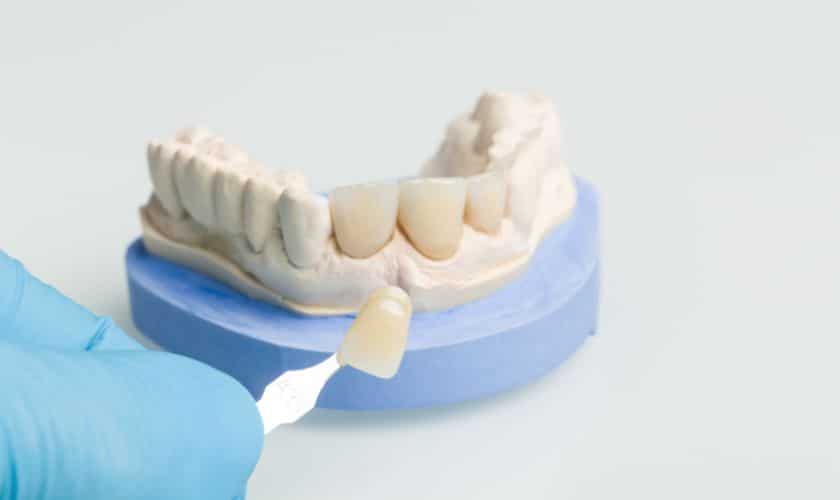 Crown Lengthening in Danville