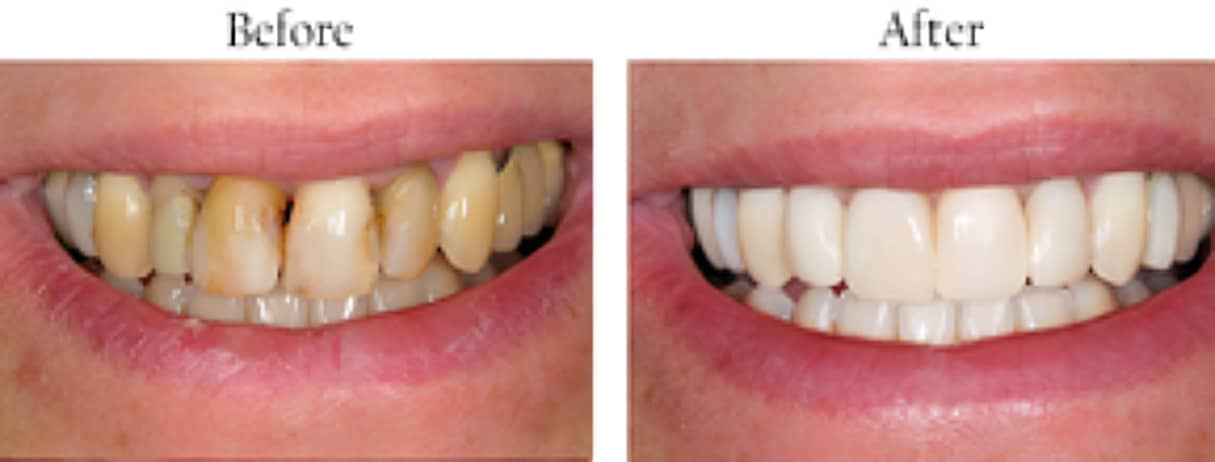 Before and after of a teeth 2