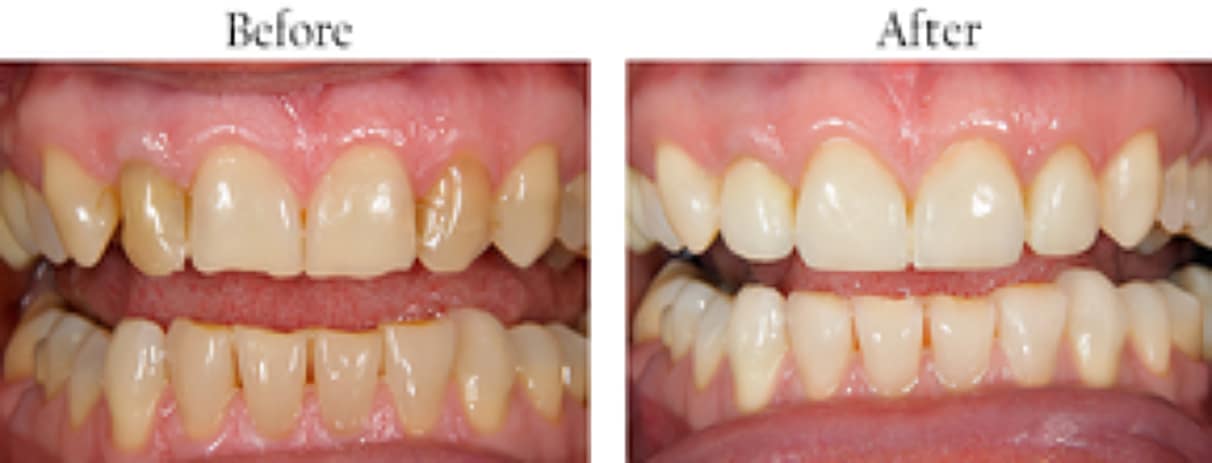 Before and after of a teeth
