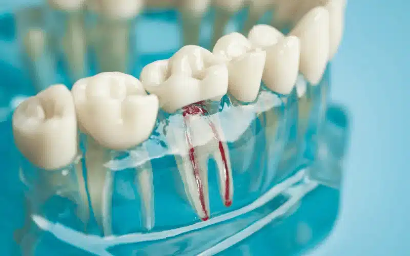 Does Root Canal Treatment Hurt