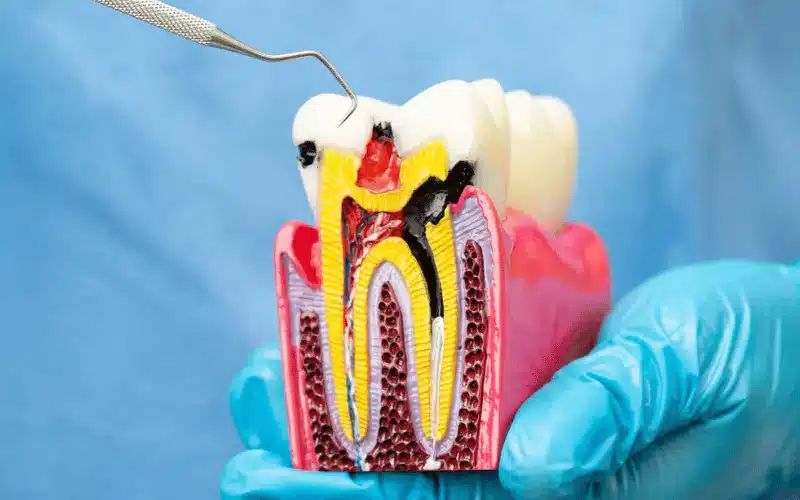 What Happens If You Delay Root Canal Treatment?