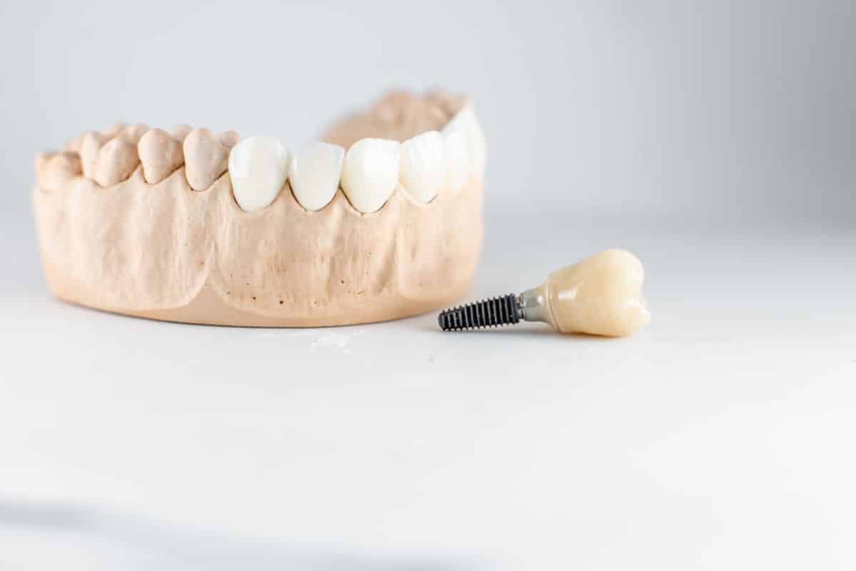 Types Of Dental Implants