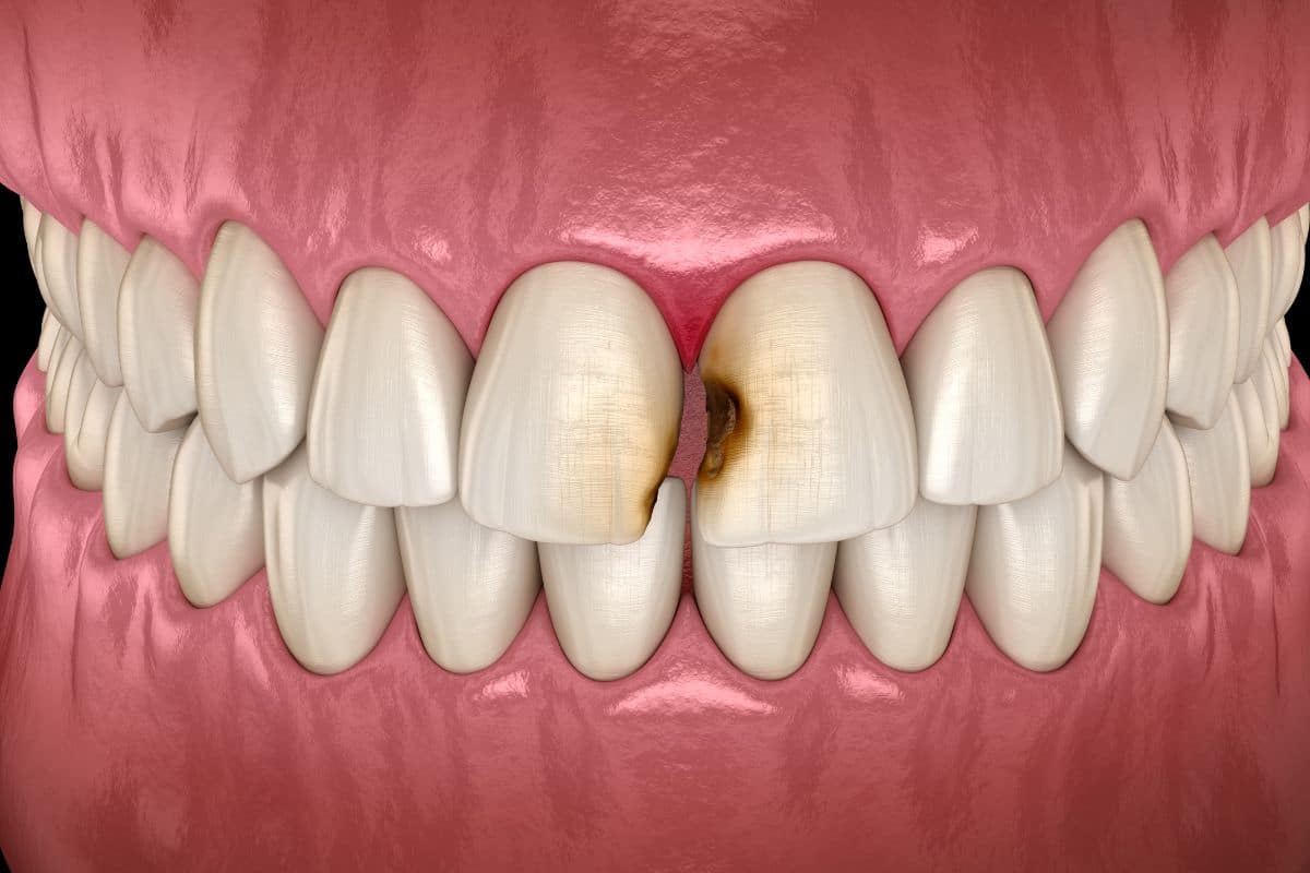 How to Prevent an Abscessed Tooth