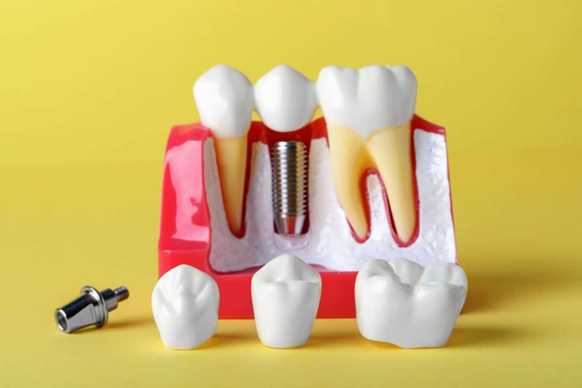 Single Tooth and Multiple Teeth Implants