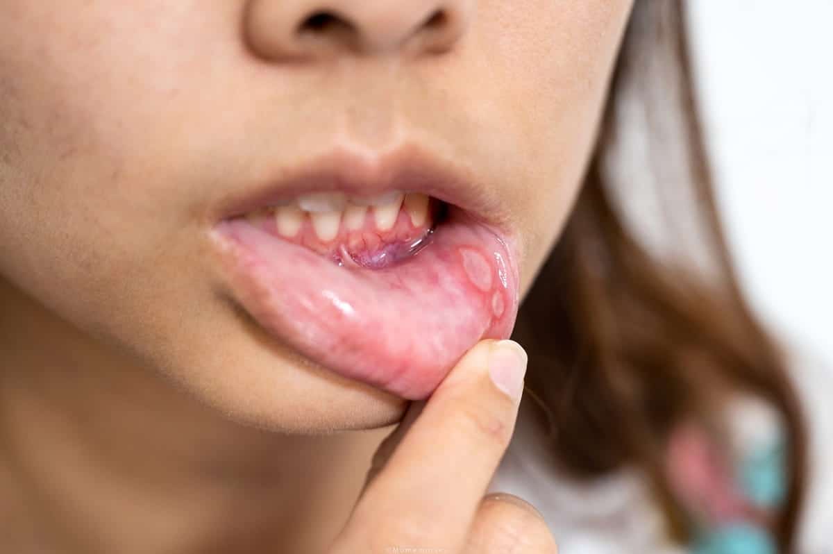 Can You Go To The Dentist With a Cold Sore